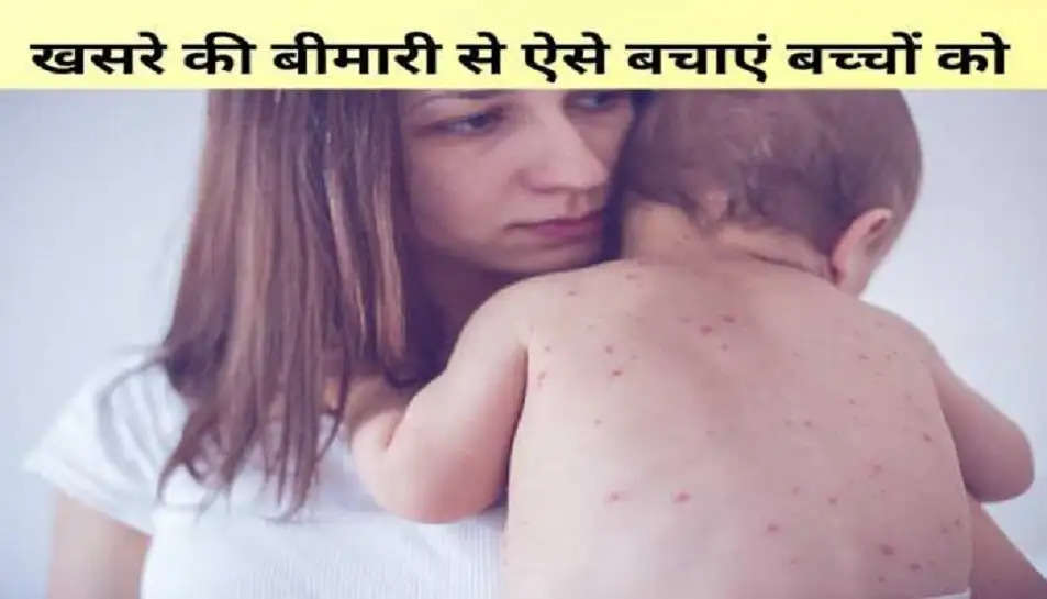 Measles virus: बच्चों पर खसरा बीमारी का खतरा मंडराया, मुंबई में फैल रहा संक्रमण; ऐसे करें बचाव